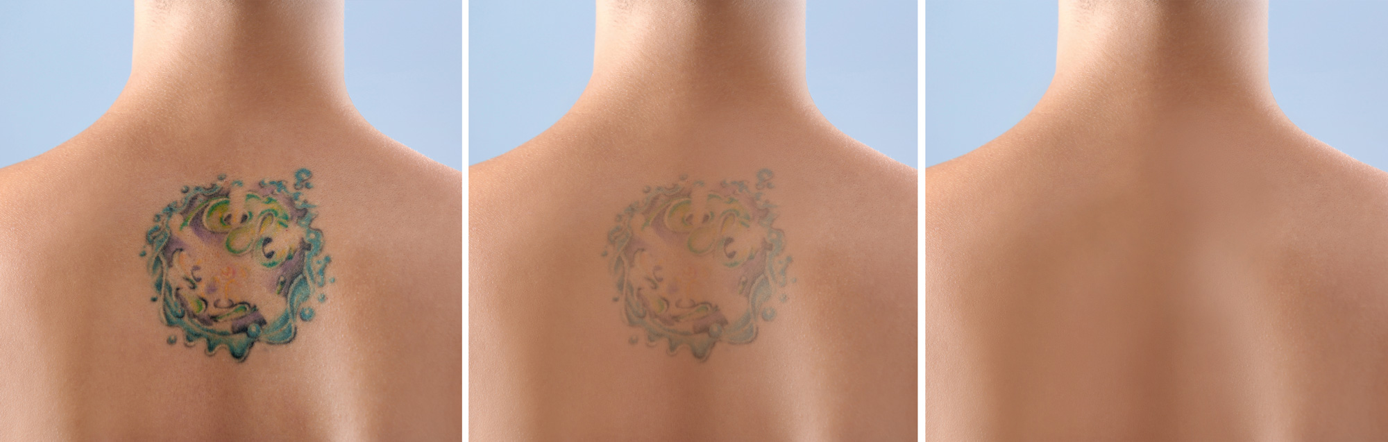 resultaat-tatoeage-verwijderen